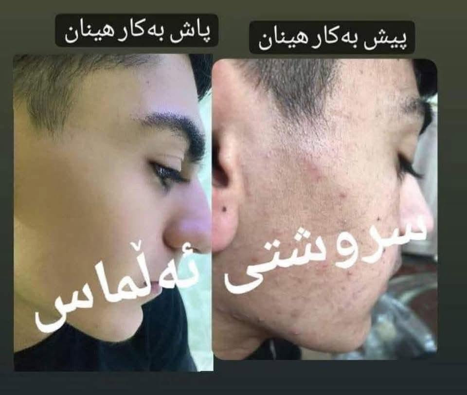 تۆش بەدەست کێشەکانی پێستەوە دەناڵێنی نازانی چی لێبکەیت و بەچی چارەسەری بکەیت🤔
کرێمێکت دەوێت بەگرەنتی👌 پارەگەڕانەوە ئەگەر سوودی نەبوو لەماوەی تەنها 🔺١٥ڕۆژدا
🟡سێتی کرێمی ئەمەریکی ئەڵلماس کەخاوەنی کوالێتی کۆنترۆڵە ☑️
ئەوەی ئەم کرێمەی بەکارهێناوە بۆهەمیشەیی ماڵئاوای لەتەواوی کێشەکانی ڕوخساری کردوە و دەوروبەری داوای ئەم کرێمەیان لێکردوە بەهۆی سوودو گۆڕانکاریە زۆرەکەیەوە 👍
ئەم کرێمە چارەسەری تەواوی ئەم کێشانەی ڕوخسارت بۆدەکات بەگرەنتیەوە 
🔺لابردنی زیپکەو شوێنەواری زیپکە
🔺لابردنیی پەڵەی سەرپێست و ژێرپێست
🔺لابردنی ڕەشی ژێرچاوو یەک ڕەنگ کردنی روخسار بەتەواوی
🔺لابردنی سوتاوی بەرخۆرو نەرم کردن و سافکردنی دەماوجاوو بەگشتی یەک ڕەنگردنی 
🟡کارتی گرەنتی و زەمانی بەکارهێنانی لەگەڵدایە سوودی تەواوت وەرنەگرت قەرەبوی تەواو دەکرێیتەوە 
بۆداواکردن و زانیاری زیاتر پەیوەندی بەم ژمارەیەوەبکەن
🚕گەیاندنمان بەردەستە 
📞***********
