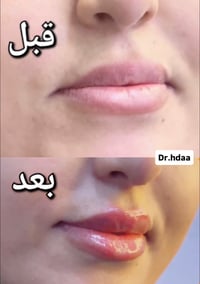 جلسة فيلر • جلدية وتجميل • مركز الهدى