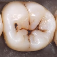 علاج مجاني بالكامل ‼️ لحالات التسوس بالحشوات التجميلية قلع الجذور التا...