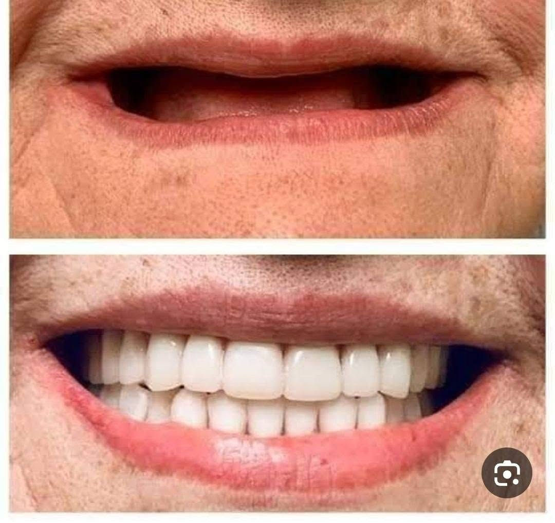 علاج مجاني • قلع وحشوات • طقم أسنان