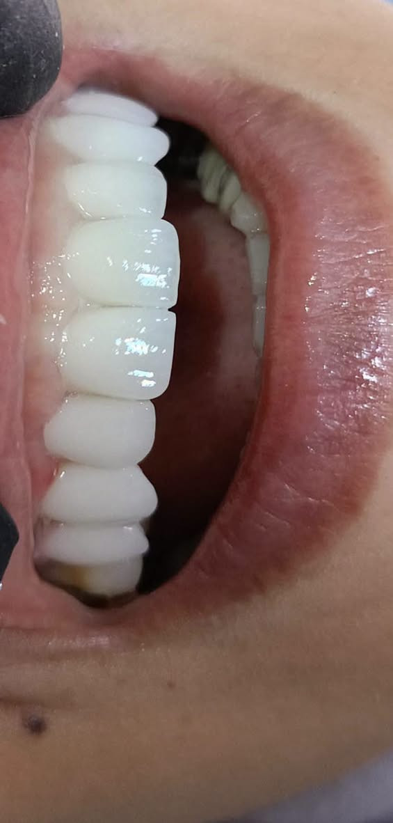 ✨ ابتسامة وثقة 🩵

عيادات الفرح لطب وتجميل الأسنان – فرع حي النصر 🦷

تعويض الأسنان بأسنان( الزاركون الألماني) وابتسامة جميلة 💯

🦷 ابتسامتك ويّا عيادات الفرح غير
🛡️ ضمان مدى الحياة

📍 العنوان:
حي النصر / شارع السوق / خلف جامع الإمام المهدي
فوق صيدلية مصطفى جاسم أو أسواق الزعيم

📞 ***********

⏰ الدوام: من 4 عصراً إلى 9 مساءً
