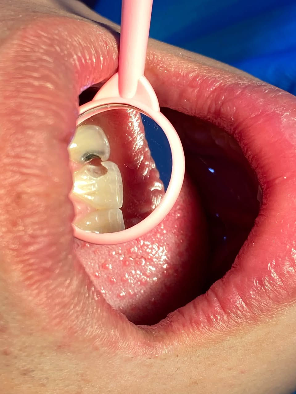 السلام عليكم 
 حشوات  تجميليه ، قلع جذور متبقيه وقلع جراحي 
تنظيف الأسنان من التكلسات والتصبغات 
كُل هذا تحت إشراف دكاتره مختصين 
علماً العلاج مجاني 🔥🔥 
العنوان : حي النقيب عيادات جامعه الصفوه 
للحجز ؏ هذا الرقم :***********
