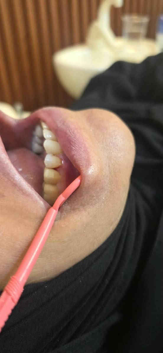 تجميل أسنان • تركيب سن • قبل وبعد