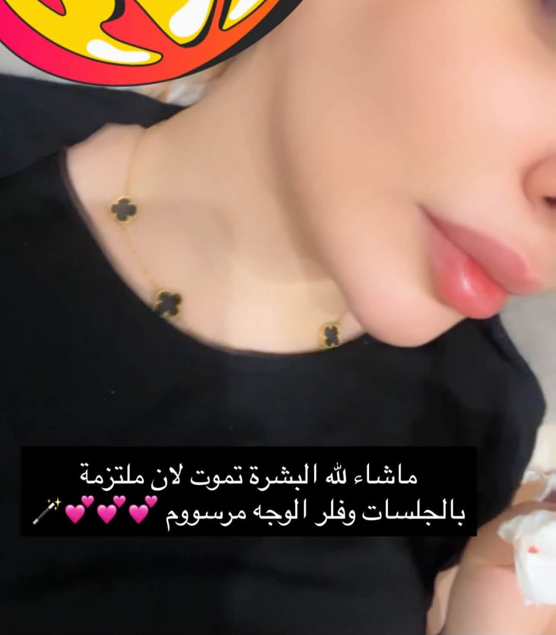 فلر الوجه • بعد الحقن • ملتزمة بالجلسات