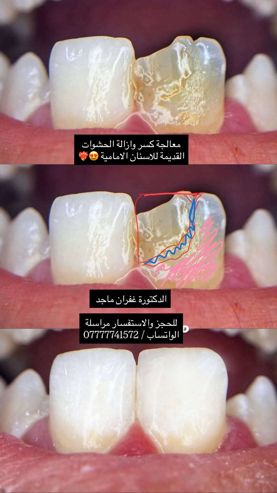 دكتورة غفران • حشوة ضوئية • كسر سن أمامي