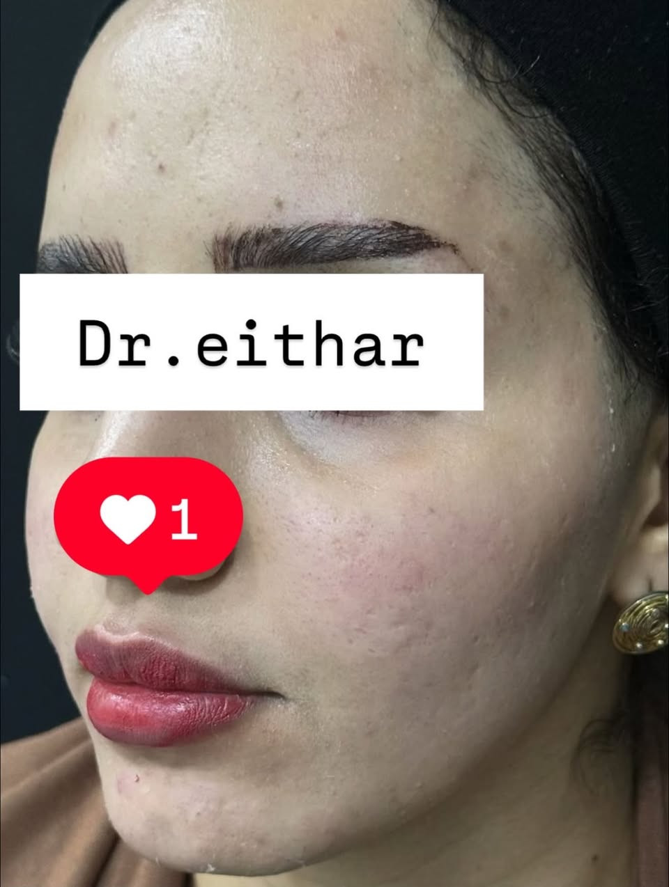 كونتور الوجه بالفلر  (لفتنك وجنات  واصداغ وتدوير الفك والذقن ونظاره وشفة تعديل ع حقن سابق للشفة) 🔥🔥
لاحضو الفرق بالذقن ومنطقه الفك   شكد تغير الشكل🔥
عروووض للكادر التدريسي والخريجات والموظفات والعروسات  ثبتتهه الكم بالستوري بالهايلايت وببوست اعلى الصفحة ✨✨

د.ايثار سامي عبد الامير
واسط الكوت الهوره مجمع القبطان طابق اول 

الحجز***********

نص مكتوب في الصور:
- Dr.eithar 1