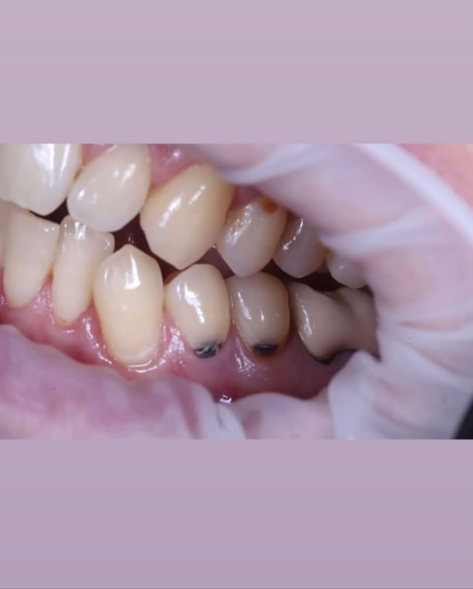 السلام عليكم 🌷🦷
حاليًا أستقبل بعض الحالات لعلاج الأسنان بشكل مجاني ، واللي يحتاج علاج أو يعرف أحد محتاج يراسلني خاص حتى أشوف الحالة وأوضح التفاصيل.

الحالات اللي أشتغل عليها حاليًا للكبار او الاطفال :
• حشوات الأسنان (حشوه بيضاء بلون السن بجلسه واحده)
• تنظيف وعلاج اللثة 
• قلع الأسنان والجذور التالفه
• تعويض الاسنان بطقم متحرك 
• العلاج بماده الفلورايد والسيلر لاسنان الاطفال
• وبعض الحالات الأخرى حسب الحالة

📍 المكان: [بابل طريق حله نجف عيادات جامعه المستقبل]
📩 للتفاصيل والحجز مراسلتي خاص.
     او واتساب ***********

الصور الي جوه توضيحيه مو تشوفوهن وتشردون🌚😂

نص مكتوب في الصور:
- تقويم الأسنان تعويض الأسنان بطقم متحرك حشوات تجميلية العلاج مجاني في بابل قلع الأسنان علاج أسنان الأطفال حشوات قلع العلاج الوقائي لأسنان الأطفال بالفلورايد والسيلر تنظيف الأسنان أسنان صحية ابتسامة أجمل مستقبل أفضل Small steps Big smiles Dentistry Oral Health Better Smiles