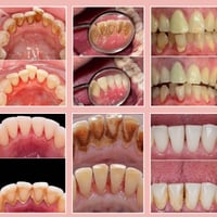 تنظيف أسنان • علاج مجاني • جامعة المستقبل