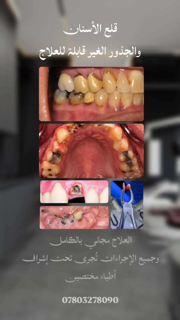 عـلاج الأسنان بالمجـان 
اي شخص يحتاج حشوات تجميلية دائمية 
قلع الأسنان والجذور التالفة
تنظيف اسنان وازالة التكلسات 
تعويض الأسنان المفقودة بطقم جزئي 

يتواصل ويانه ***********
العـلاج يكون مجـانـي بالكـامل وتحت إشـراف أطبـاء مختـصين 

العنوان / ناصرية - شارع النيل - بحي الشهداء - جامعة العين - مستشفى العين لطب الأسنان

نص مكتوب في الصور:
- تنظيف الأسنان وأزالة التكلسات والتصبغات العلاج مجاني بالكامل وجميع الإجراءات تُجرى تحت إشراف أطباء مختصين ***********
- قلع الأسنان والجذور الغير قابلة للعلاج العلاج مجاني بالكامل وجميع الإجراءات تُجرى تحت إشراف أطباء مختصين ***********
- أزالة التسوس وترميم الأسنان بالحشوات التجميلية العلاج مجاني بالكامل وجميع الإجراءات تُجرى تحت إشراف أطباء مختصين ***********
- تعويض الأسنان بطقم جزئي أو كامل متحرك العلاج مجاني بالكامل وجميع الإجراءات تُجرى تحت إشراف أطباء مختصين ***********