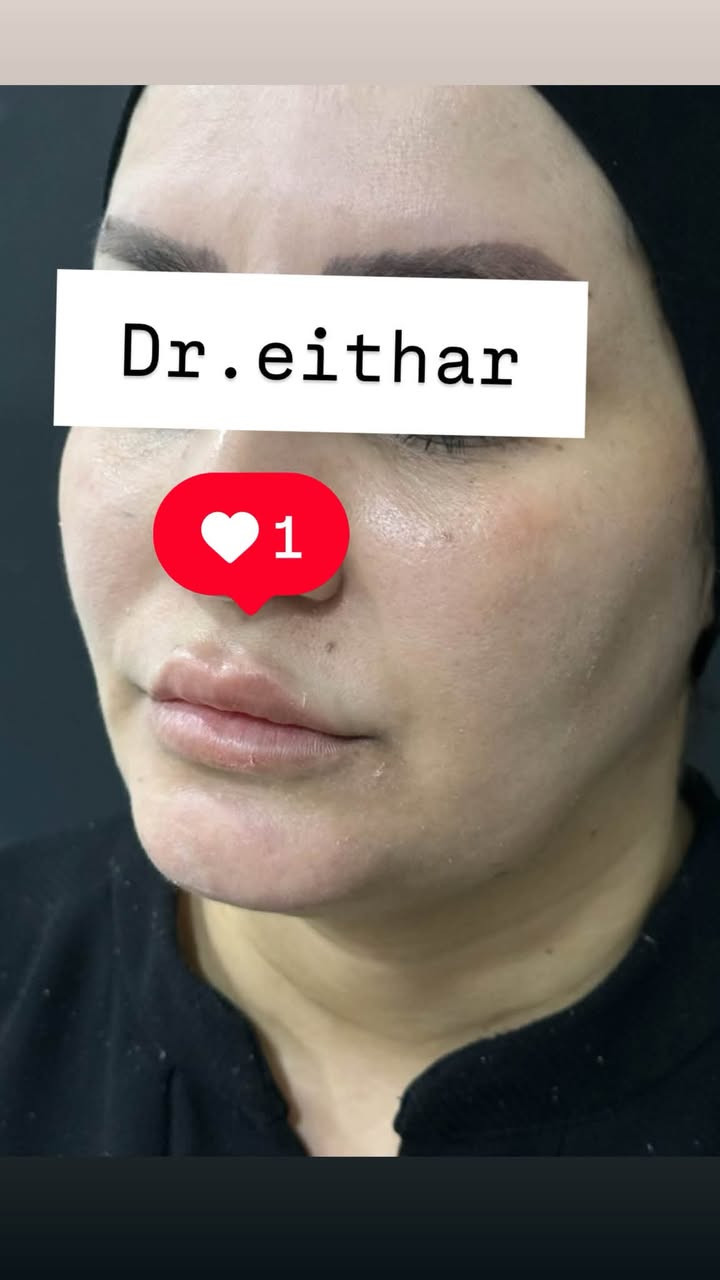 شد لفتنك الوجه بالمحفزات  وفلر شفه  بالفلر الايطالي 🔥🔥🔥
عروووض للكادر التدريسي والخريجات والموظفات والعروسات  ثبتتهه الكم بالستوري بالهايلايت وببوست اعلى الصفحة ✨✨

د.ايثار سامي عبد الامير
واسط الكوت الهوره مجمع القبطان طابق اول 

الحجز***********

نص مكتوب في الصور:
- Dr.eithar 1