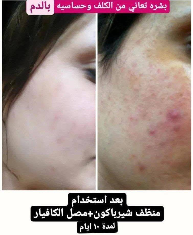 السلام عليكم :
الكتابة
✨ عناية لبشرتك… لأنك تستحق الأفضل ✨
نوفر لكم مجموعة مميزة من منتجات العناية بالبشرة للرجال والنساء 🧴💆‍♀️💆‍♂️
🇮🇷 منتجات إيرانية من شركة لدورة 🌿
💗 منتجات للنساء والرجال
💗 استشارة مجانية لاختيار المنتج المناسب
💗 متابعة الزبون كل أسبوع
💗 متابعة مستمرة وإرشادات لطريقة الاستخدام
📲 متواجدين على الواتساب للاستفسار والطلب:
***********
***********
✨ تواصلوا ويانا، والاستشارة مجانية ✨

نص مكتوب في الصور:
- بعد استعمال بكج التساقط من ماركة لدورا
- قبل بعد
- بشره تعاني من الكلف وحساسيه بالدم بعد استخدام منظف شيرباكون+مصل الكافيار لمدة ١٠ ايام
- بعد استخدام ١٠ ايام من المنتجات
- بعد
- قبل
- بعد استخدام عصاره الليكس