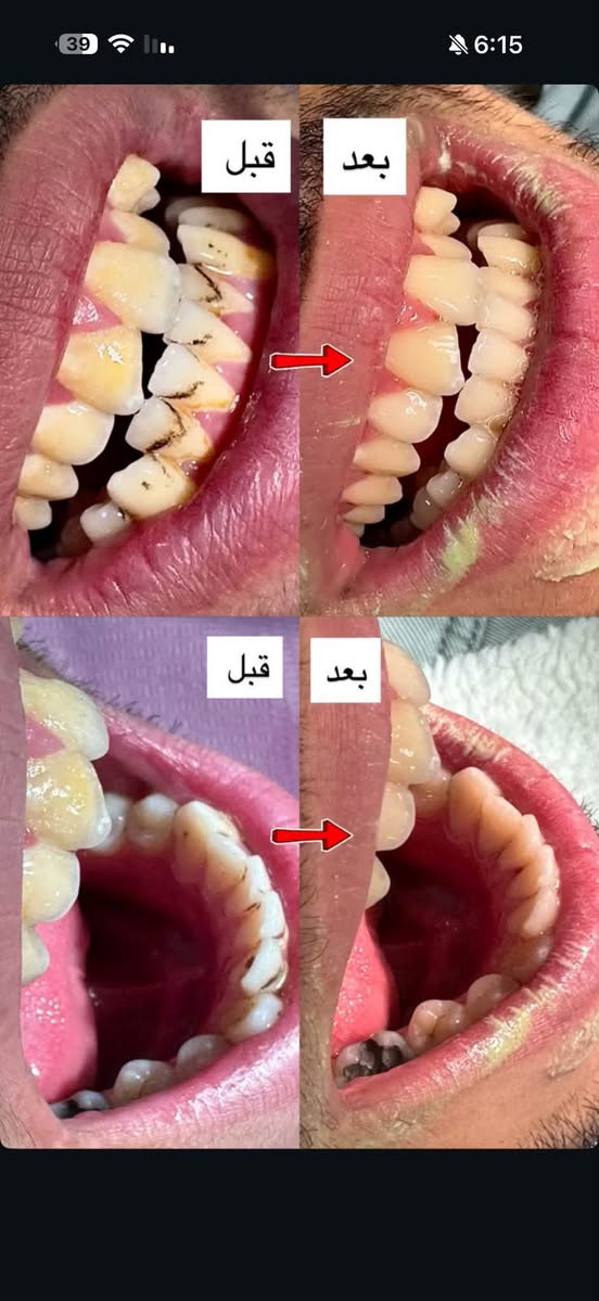 تنظيف اسنان • مجانا • جامعة الزهراوي