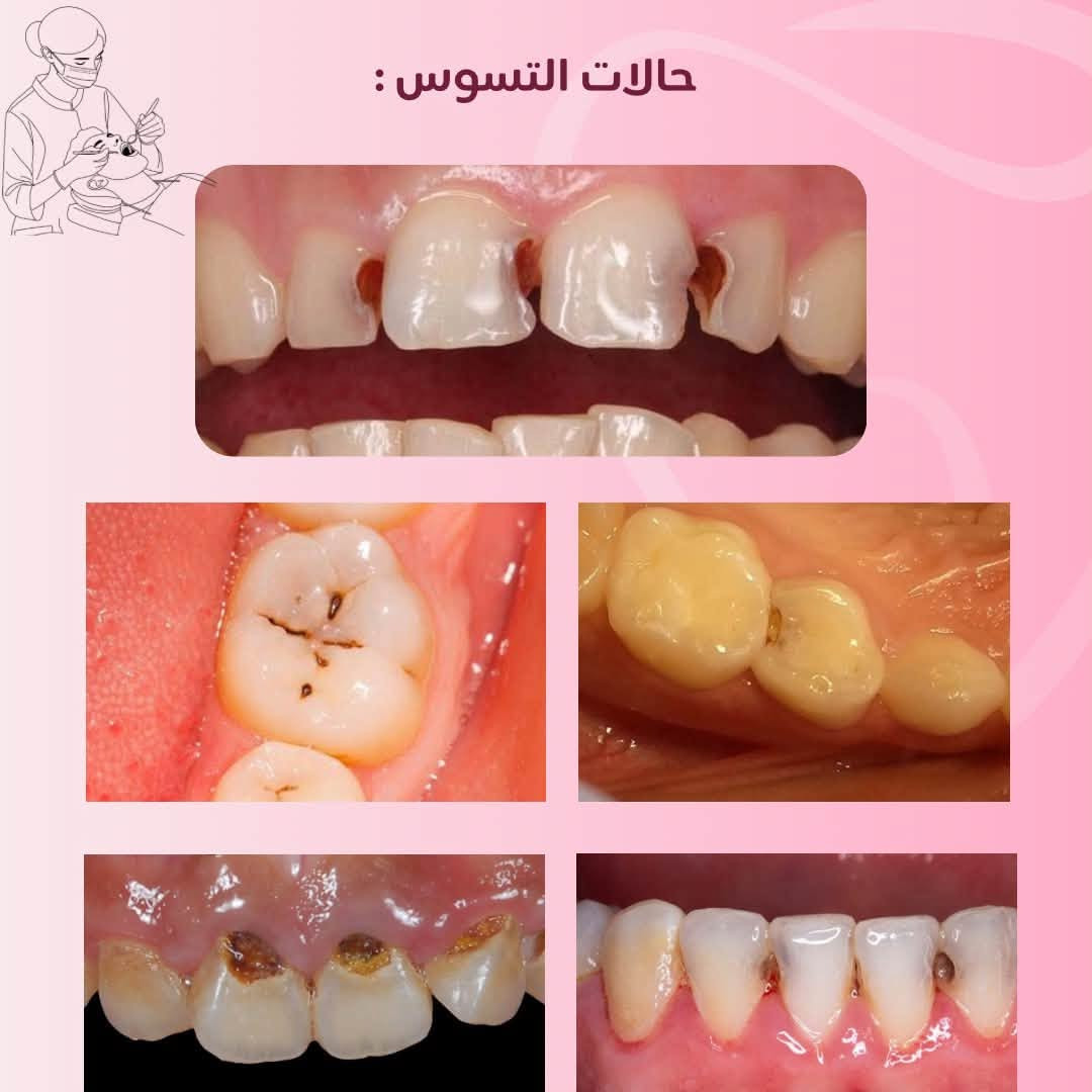 اي استفسار اني حاضرة راسلوني خاص وبعيوني 🤍

نص مكتوب في الصور:
- تجنب وجع الاسنان بالكشف المبكر د/سالي محمد خدماتنا : حشوات ضوئية علاجية للأسنان المتسوسة تنظيف الأسنان وازالة التكلسات وتبييض الأسنان تعويض الأسنان المفقودة بطقم جزئي قلع الأسنان وبقايا الجذور التالفة العلاج مجاني تحت إشراف كادر أطباء مختصين العنوان : جامعة البيان - مستشفى البيان التعليمي بغداد - شارع المطار *********** Sos19m_ Soss204
- حالات التنظيف المطلوبة
- حالات التسوس :
- الحالات التي تستوجب تعويضها ب طقم جزئي متحرك :
- الاسنان وبقايا الجذور التي تستحق القلع: