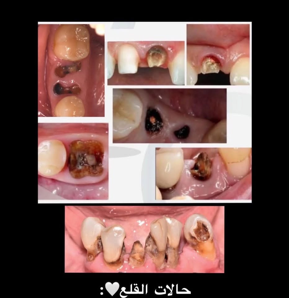 السلام عليكم
حالات مطلوبة للعلاج في جامعة المستقبل والعلاج مجاني 
1-حشوات لاغلب حالات التسوسات 
2-تنظيف اسنان من التكلسات والتصبغات 
3-قلع الجذور المتبقية والاسنان الهالكة غير قابلة للعلاج
4-تعويض الاسنان المفقودة بطقم جزئي متحرك
*علمًا العلاج يبدأ في بداية الاسبوع المقبل للحجز والاستفسار التواصل على
واتساب//***********
او انستا // zozo_zozoo17

نص مكتوب في الصور:
- 1-التسوس يكون بوسط السن. 2-تسوس بين الأسنان. (الأسنان الخلفية) 3-تسوس بين الأسنان. (الأسنان الأمامية) 4-تسوس او كسر للحافة القاطعة للأسنان الأمامية. 5-تسوس عند حافة اللثة.
- حالات القلع:
- تعويض الأسنان بطقم جزئي متحرك: