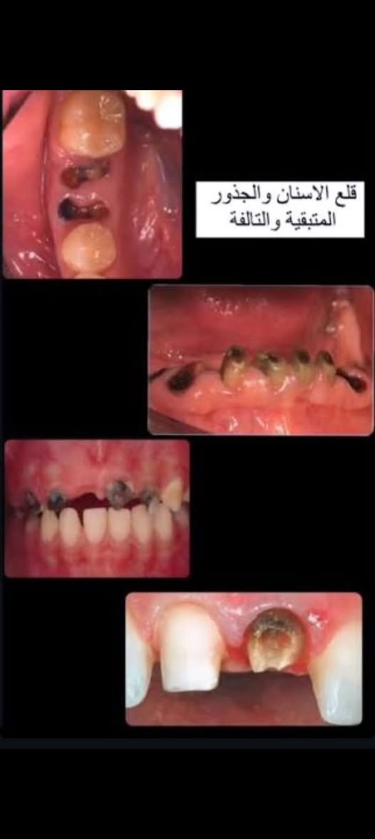 مرحبا اي شخص محتاج قلع أو تنضيف تكلسات حصرا مثل الصوره علاج مجانآ عنوان بغداد العلاوي شارع ٦ مجاور مستشفى الكرامه عيادات الجامعه المستنصريه يتواصل وياي على *********** واتساب
