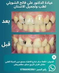 حشوات ضوئية • تجميل أسنان • قلعة سكر