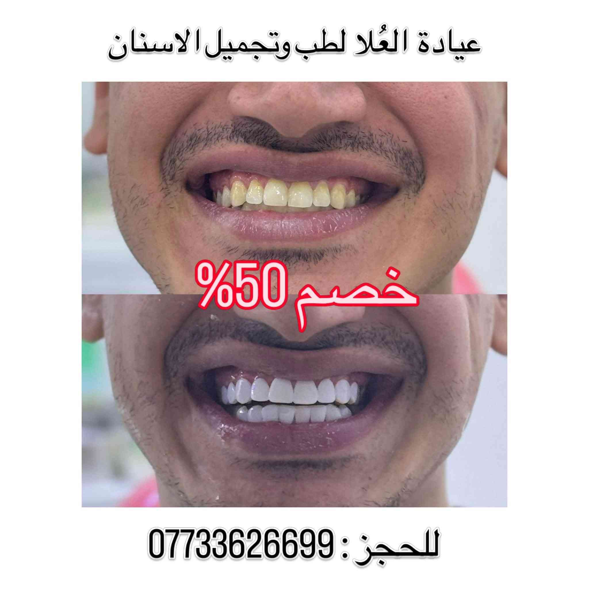 خصم ٥٠٪ • ابتسامة هوليوود • الشرطة الخامسة