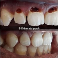 تسوس اللثة • مجاني • عيادات الجامعة الوطنية