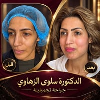 ✨ نتائج طبيعية تعيد للوجه نضارته وتناسقه ✨ قبل وبعد إجراء تجميلي بإشرا...
