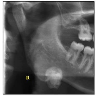 🩻 دور الأشعة الرقمية DR في تشخيص حصوات الغدد اللعابية
هل تعاني من ألم أو تورم في منطقة الفك أو تحت اللسان، خصوصًا أثناء تناول الطعام؟
قد تكون هذه الأعراض مرتبطة بوجود حصوات في الغدد اللعابية.
🔍 تساعد الأشعة الرقمية DR في الكشف عن بعض حصوات الغدد اللعابية، خصوصًا الحصوات التي تحتوي على نسبة عالية من الكالسيوم وتظهر بوضوح في صورة الأشعة.
📌 أهم الأعراض التي تستدعي الفحص:
• تورم متكرر في الغدة اللعابية. 
• ألم يزداد أثناء تناول الطعام. 
• جفاف الفم أو صعوبة في إفراز اللعاب. 
• ألم أو انتفاخ أسفل الفك أو تحت اللسان. 
✨ التصوير بالأشعة الرقمية يتميز بـ:
✅ سرعة إجراء الفحص. 
✅ وضوح ودقة الصورة. 
✅ إمكانية المساعدة في تحديد موقع الحصوة. 
✅ دعم الطبيب في اختيار الإجراء التشخيصي أو العلاجي المناسب. 
📍 عيادة العامل للأشعة الرقمية DR
دقة في التصوير… وسرعة في النتائج… وثقة في التشخيص.
🩻 إذا كنت تعاني من أعراض متكررة، فالفحص المناسب يساعد في الوصول إلى التشخيص الصحيح.
صحتكم.. اهتمامنا
متواجدين طيلة ايام الاسبوع مع يوم الجمعة من الساعة(4-8) مساءً بوجود كادر نسائي متمرس والعيادة طابق ارضي
حي العامل.. السوق الشعبي.. شارع الأطباء.. مجاور صياغة الزيدي.. مقابل مكتب السيد الشهيد محمد صادق الصدر (قدس سره) 
للاستفسار الاتصال على الرقم :***********
