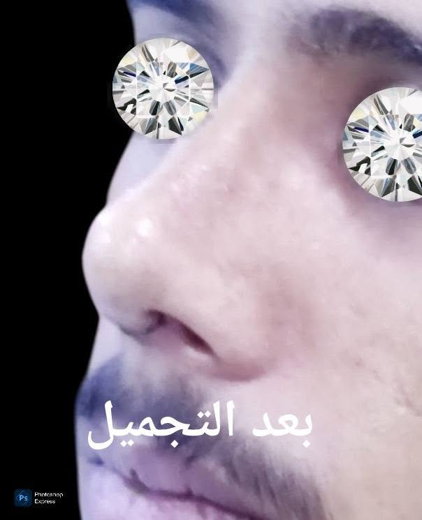 تجميل الانف • طبيعي • قبل وبعد