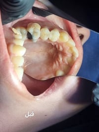 طاحن علوي • حشوة تجميلية • عيادة كوثى