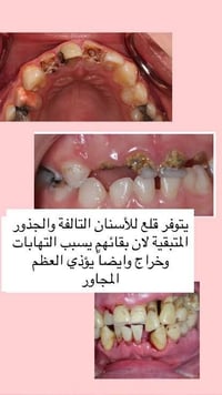 قلع أسنان • مجانا • الناصرية