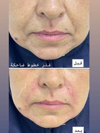 فلر خطوط ضاحكه • ١ سي سي • بابل القاسم