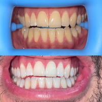 عيادة أسنان • جامعة الكوفة • حشوات تجميلية