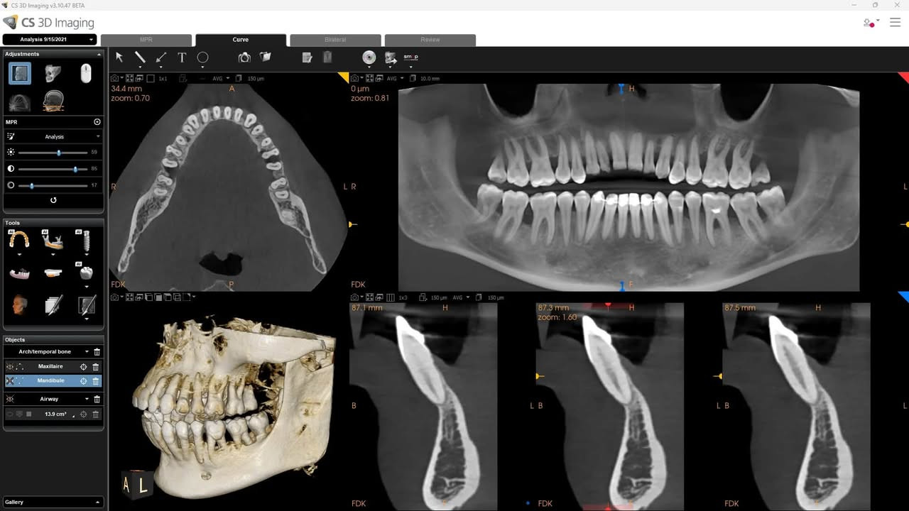 جهاز CBCT Caresteam 8200
السلام عليكم جهاز CBCT شركة كيرستريم من الوكيل حصراً
للبيع مستعمل 9 اشهر فقط جداً نضيف مخزون في مخزن الوكيل
احدث سوفت وير فيلد يصل الى 16x10
المكان بغداد - للتواصل والاستفسار ***********

نص مكتوب في الصور:
- 1 2 3 4 5 6 7 8 12.8 mm RT.5 RT.4
- CS 3D Imaging v3.10.47 BETA Analysis 9/15/2021 MPR Curve Bilateral Review Adjustments Analysis 59 85 17 Tools AI 34.4 mm zoom: 0.70 R L A P FDK 0 um zoom: 0.81 1x3 87.1 mm H B FDK 150 um AVG 150 um 87.3 mm zoom: 1.60 H L B FDK FDK 87.5 mm H L B L Objects Arch/temporal bone Maxillaire Mandibule Airway 13.9 cm³ Gallery