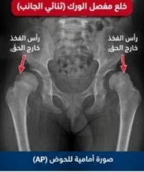 خلع الورك الولادي • سونار أطفال • عيادة العامل