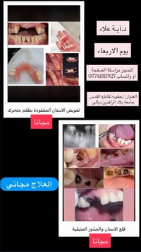 تعويض اسنان • طقم متحرك • بعقوبه