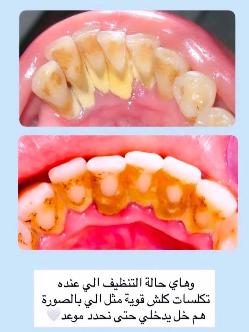 السلام عليكم ،  كل شخص حاجز عندي يرجى مراسلتي لتثبيت الموعد

و  الي محتاج حشوات ضوئية او قلع او تنظيف الأسنان و ازالة التكلسات يراسلني اشتغلهم اله في عيادات جامعة الكوت تحت إشراف أطباء اختصاص 🌸✔️

🤍 إذا ما تكدرون تلتزمون بالموعد، ياريت تخلّون المجال لغيركم.

نص مكتوب في الصور:
- *********** بغداد - زيونة - شارع الربيع
- Class3
- Class4
- Dr.Ebtisam abo igrarah Class5
- وهاي حالة التنظيف الي عنده تكلسات كلش قوية مثل الي بالصورة هم خل يدخلي حتى نحدد موعد
- واخيرا الي عنده اطفال محتاجين قلع او محتاجين حشوة واسنانهم اللبنية تعبانة هم خل يتواصل وياي نسويهن الهم جديدات 🦷🤍