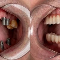 زراعة اسنان • طبيب اخصائي • حي الصحة - الدورة