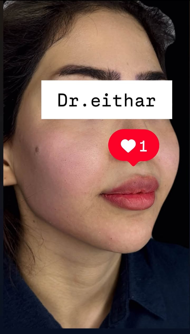 كونتور الوجه وشد بالفلر  (لفتنك وجنات  واصداغ وتدوير الفك والذقن ونظاره) 🔥🔥🔥

اتمددت عروووض للكادر التدريسي والخريجات والموظفات والعروسات لنهايه الاسبوع ليوم الاربعاء اخر يوم  ثبتتهه الكم بالستوري بالهايلايت وببوست اعلى الصفحة ✨✨

د.ايثار سامي عبد الامير
واسط الكوت الهوره مجمع القبطان طابق اول 

الحجز***********

نص مكتوب في الصور:
- Dr.eithar 1
- Dr.eithar
- 1