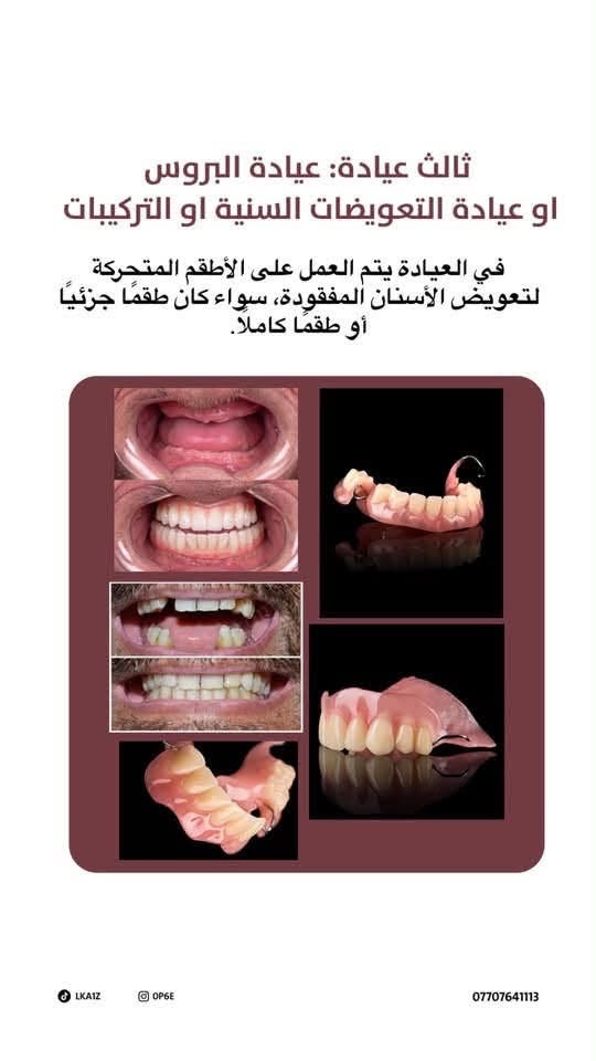 لا توجد تفاصيل

نص مكتوب في الصور:
- وراح تكون كل العيادات مجانية بالكامل وتحت اشراف مختصين تعالوا وياي اكلكم شنو راح نسوي LKAIZ OPGE ***********
- تتكون من عدة عيادات عيادة الحشوات عيادة الجراحة عيادة أمراض اللثة والتنظيف عيادة البروس او عيادة التعويضات السنية او التركيبات عيادة التقويم للاطفال عيادة الأطفال عيادة الأطفال الوقائية LKA1Z OP6E ***********
- أول عيادة: عيادة الجراحة في عيادة الجراحة يتم إجراء قلع الأسنان والجذور المتبقية، بالإضافة إلى القلع الجراحي للحالات التي تتطلب تدخلاً جراحياً، مثل قلع أضراس العقل وغيرها من الحالات. ***********
- ثاني عيادة: عيادة الحشوات
- في عيادة الحشوات يتم إجراء الحشوات التجميلية للأسنان المتسوسة أو المكسورة، وكل حالة تحتاج إلى حشوة. كما يتم إجراء حشوات الجذر للأسنان الأمامية فقط.
- LKA1Z
- OP6E
- ***********
- ثالث عيادة: عيادة البروس او عيادة التعويضات السنية او التركيبات في العيادة يتم العمل على الأطقم المتحركة لتعويض الأسنان المفقودة، سواء كان طقماً جزئيًا أو طقمًا كاملا. LKAIZ OP6E ***********