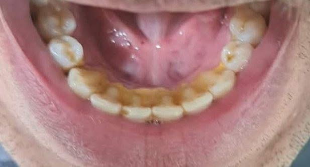 تنظف اسنان مجانا
الي عنده تكلسات قوية باسنانه مثل الي بالصورة وحاب ينظف اسنانه ويشيل هاي تكلسات يتواصل وياي ع خاص او يتصل على الرقم *********** (الشغل مجاني)
العنوان حلة شارع 40 مجاور صيدلية سلامتك
