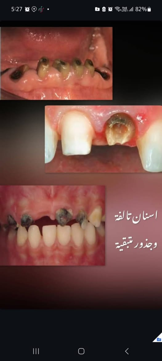 تنظيف الأسنان • إزالة التكلسات • جامعة اوروك