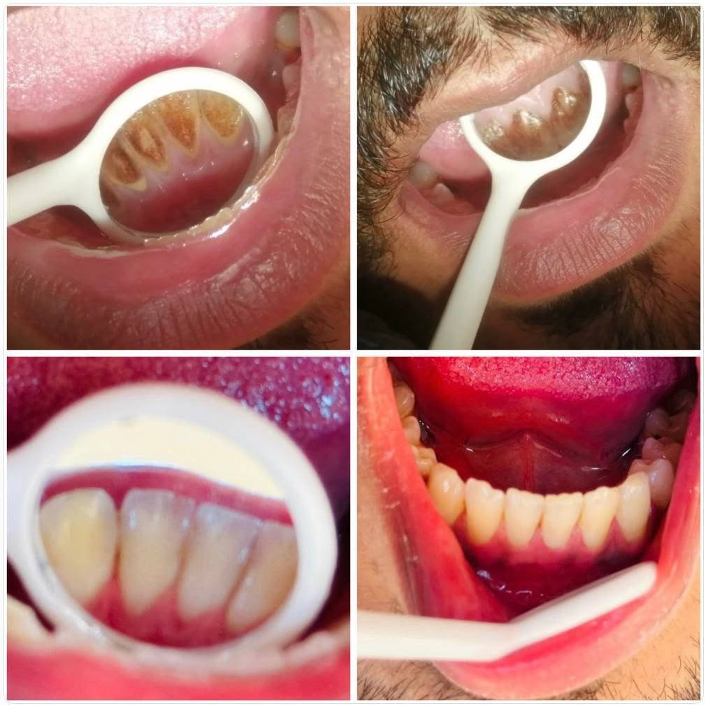 تنظيف تكلسات • طالبة طب أسنان • كلية طب الأسنان
