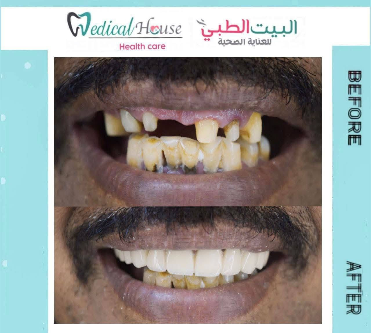 عروض الاسنان يمنه غير والي من طرفي اله خصم خاص من العياده
عيادة ألبيت ألطبي 
🦷 تنظيف وتلميع الأسنان
بدل 25 ألف
صار فقط ٢٠ ألف ✨

🦷 الحشوات الضوئية الدائمية
بدل 50 ألف
صار فقط 30 ألف 😍

🦷 تركيبات الزركون الثابتة
بدل 125 ألف
صار فقط 85 ألف 💎

🦷 تركيبات السيراميك
بدل 100 ألف
صار فقط 70 ألف 🔥

والفحص والمعاينة مجاني
✅ أفضل المواد والأجهزة الحديثة
✅ شغل تجميلي طبيعي ومضمون
✅ أسعار وعروض لفترة محدودة
✅ ابتسامة مرتبة بأقل تكلفة
📍 المحمودية – حي الموظفين – مقابل التانكي
🦷 بكج تنظيف + تلميع + تبييض الأسنان 🤍
تخلّص من التصبغات وتراكمات الأسنان، واسترجع نظافة ولمعان ابتسامتك 
🔥 بكج متكامل بسعر مميز ولفترة محدودة!
✔️ إزالة التكلسات
✔️ تنظيف وتلميع الأسنان
✔️ تبييض الأسنان
✔️ ابتسامة أنظف وأجمل ✨
📍 عيادة البيت الطبي
📞 للحجز والاستفسار: ***********
📲 الحجز متوفر عبر الواتساب

لا تخلي ابتسامتك تنتظر… احجز موعدك الآن �
