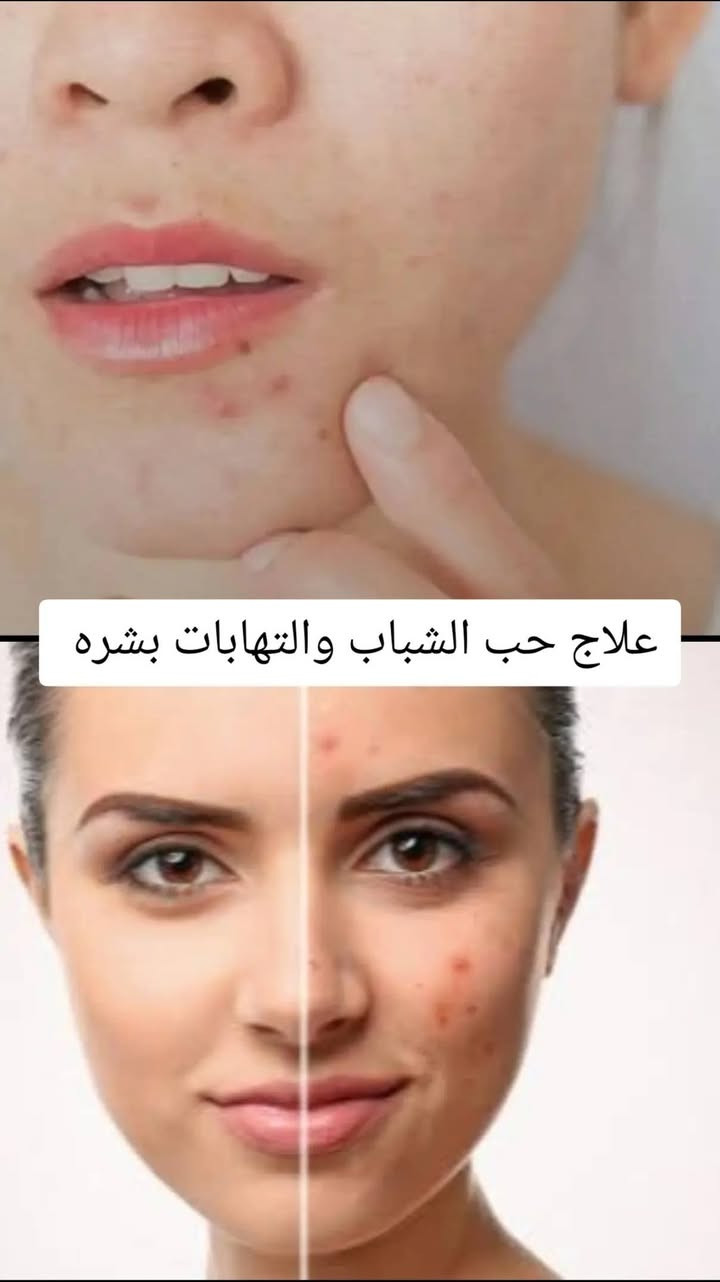تونر كولاجين • سيروم حب الشباب • مقشر كلف ونمش