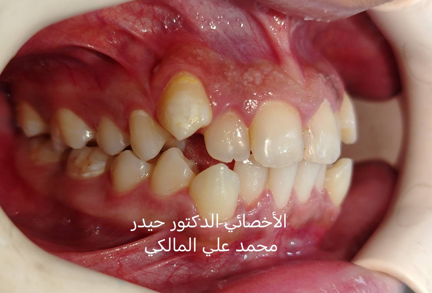 تقويم أسنان • بالتقسيط • شارع فلسطين