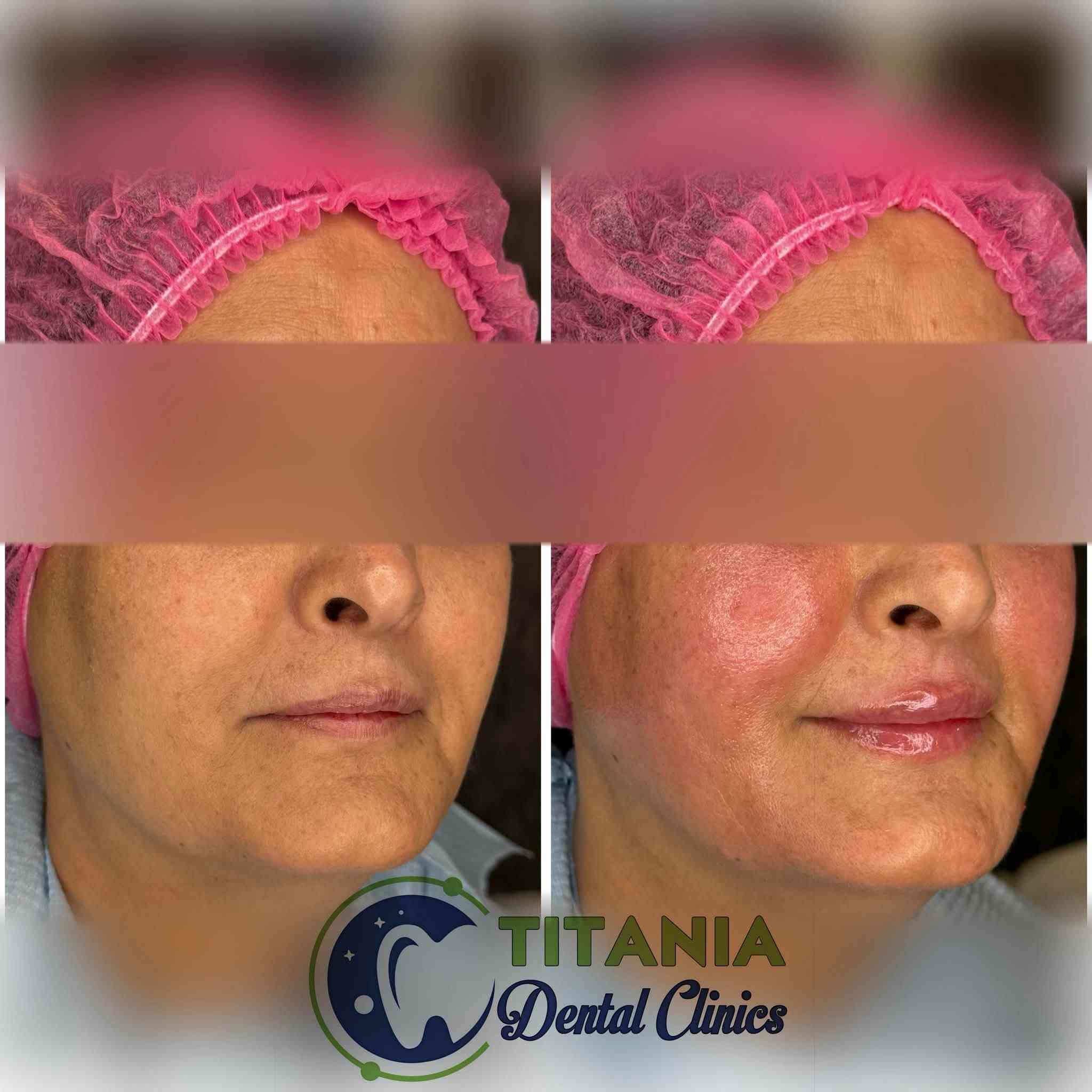 عيادات تيتانيا لطب وتجميل الوجه والاسنان
اطباء اسنان ممارسين بخبرة 7 سنوات
شهادات وعضويات عالمية بمجال التجميل اللاجراحي
تتميز عياداتنا من سنوات بتوفير المواد البراند والاصلية لأول مره بالمحافظة
وجميع المواد المتوفره مسجلة ومفحوصة وتحتوي ختم وزارة الصحة العراقية
..
وتتوفر خدمة الاقساط لحاملي بطاقات مصرف
الرافدين-الرشيد-الاهلي العراقي
..
ميسان-الماجدية-شارع الجامع
للحجز والاستفسار عبر واتس اب
***********
