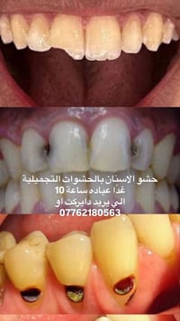 علاج مجاني • حشو أسنان • غدًا ١٠