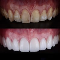 علاج مجاني • حشوات • تعويضات أسنان