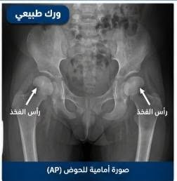 خلع الورك الولادي • سونار أطفال • عيادة العامل