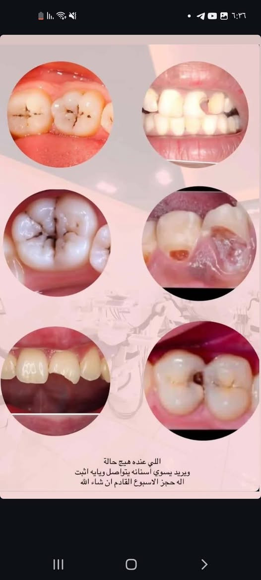 ​🦷 1_ حشوات الأسنان الدائمة الضوئية
🦷 2_ حشوات الجذور للأسنان الأمامية

​🦷 3_ تقويم أسنان متحرك

​🦷 4_ فحص وعلاج جميع حالات الأطفال

​🦷 5_ قلع الأسنان التالفة والجذور المتبقية

​🦷 6_ تنظيف الأسنان وإزالة التكلسات

​🦷 7_ تعويض الأسنان المفقودة بطقم متحرك كامل

​🦷 8_ تشخيص وعلاج الأمراض المتعلقة بالفم

​علماً العلاج مجاناً وتحت إشراف أطباء اختصاص

​📞 ***********

📍 بابل _ شارع 40 مجاور صيدلية سلامتك أولاً

​[ا

نص مكتوب في الصور:
- إذا عندكم ( طفل او بالغ ) هيج حالة تواصلوا وياي
- الحالات المطلوبة بتنظيف الأسنان هي التكلسات القويه مثل الي بالصور 👇🏻 قبل بعد
- تتوفر عيادة للأطفال لمعالجة الحالات المذكورة :
- تنظيف الأسنان و تطبيق الفلورايد لوقاية الأسنان من التسوس
- علاج تسوس الأسنان بالحشوات الدائمة
- قلع الأسنان
- اللي عنده هيج حالة ويريد يسوي أسنانه يتواصل ويايه اثبت اله حجز الاسبوع القادم ان شاء الله