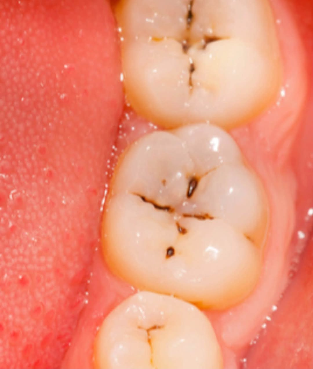 علاج مجاني وبإشراف أطباء اختصاص! 🦷✨
نستقبلكم بعيادات جامعة آشور ونقدم لكم الخدمات التالية مجاناً:
• حشوات تجميلية للأسنان
• قلع الأسنان وبقايا الجذور
• تنظيف الأسنان وإزالة التكلسات
• تعويض الأسنان المفقودة بطقم جزئي
📍 الموقع: جامعة آشور - شارع المطار
📞 للحجز: ***********
📸 إنستغرام: 8mn_tr

نص مكتوب في الصور:
- A B