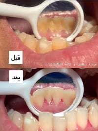 تنظيف اسنان • مجاني • عيادات اسنان