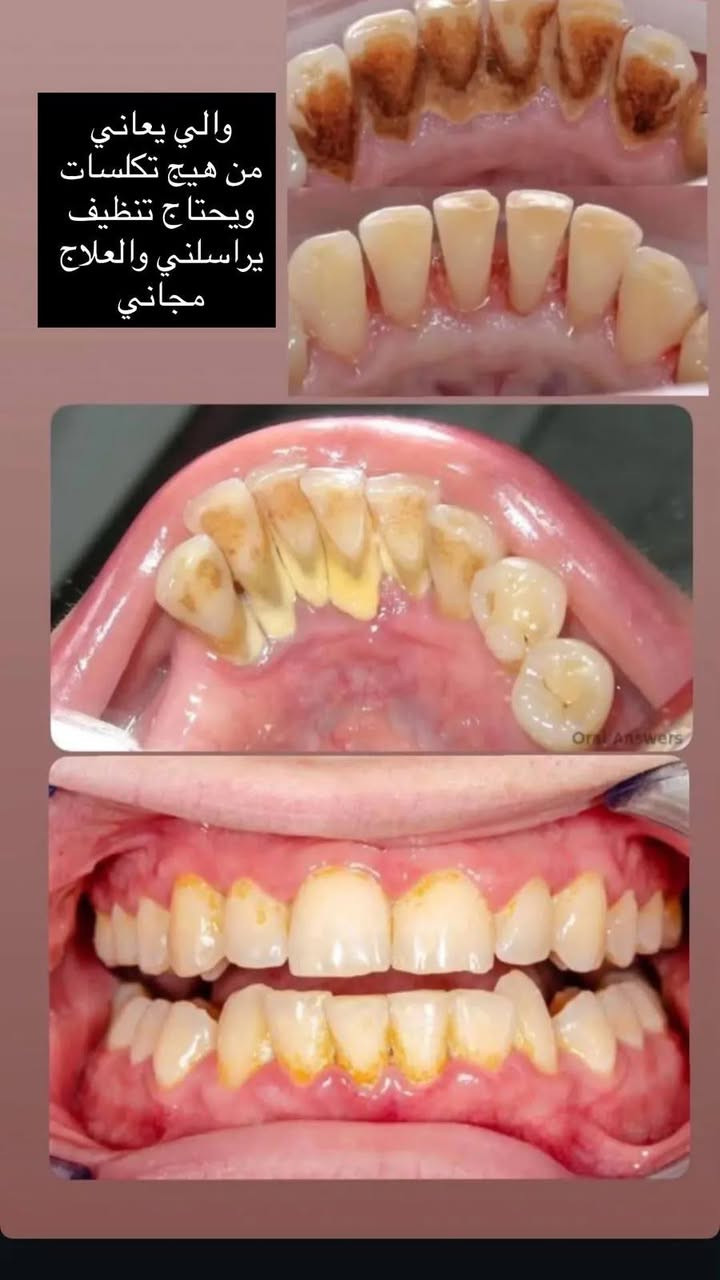 السلام عليكم اني دكتورة اسنان 
اي شخص من منطقة الامين ومحتاج
حشوات تجميلية_قلع الاسنان والجذور التالفة_تنظيف اسنان_تعويض الاسنان المفقودة بطقم جزئي متحرك
علماً ان العلاج مجاني وتحت اشراف اطباء اختصاص
للتواصل وحجز موعد ***********

نص مكتوب في الصور:
- علاج التسوسات بحشوة بيضاء قلع الاسنان وبقايا الجذور طقم متحرك جزئي
- والي يعاني من هيج تكلسات ويحتاج تنظيف يراسلني والعلاج مجاني